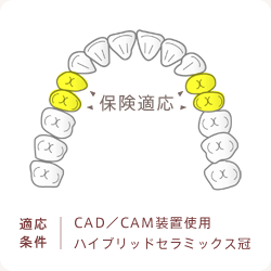 適応条件：CAD／CAM装置使用ハイブリッドセラミックス冠