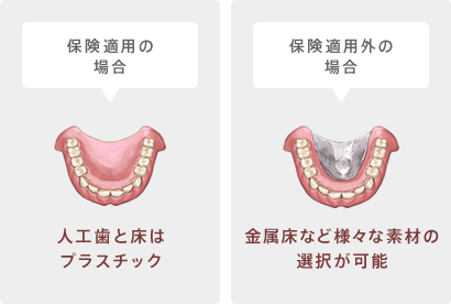 総入れ歯：保険適用と適用外の場合