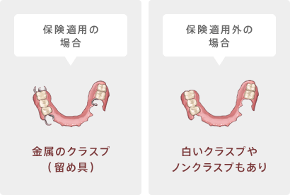 部分入れ歯：保険適用と適用外の場合