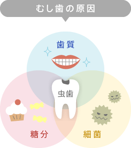 虫歯の原因「歯質」「糖分」「細菌」