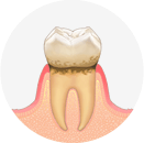 歯垢がたまります
