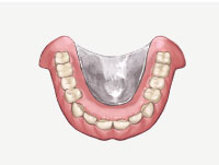 金属床義歯