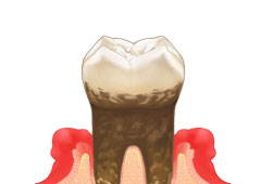 歯周病治療
